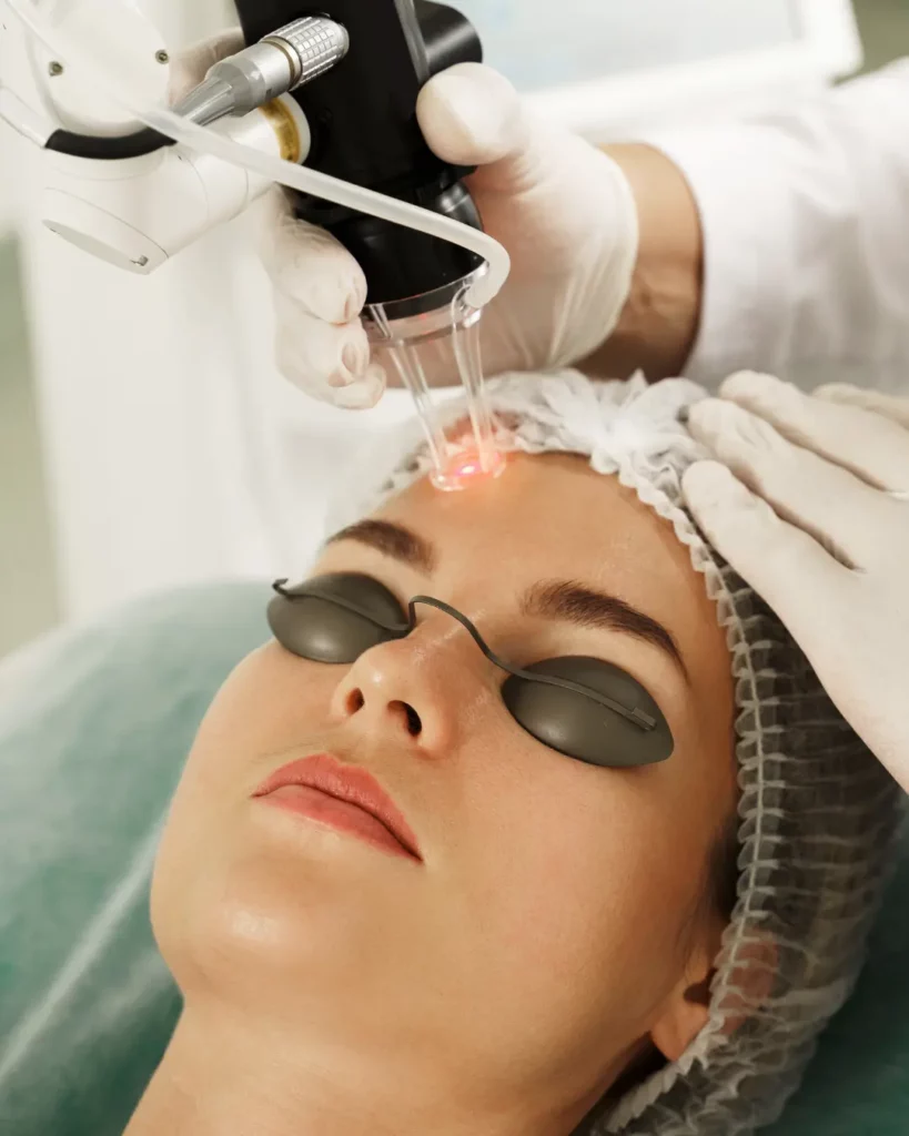 laser resurfacing